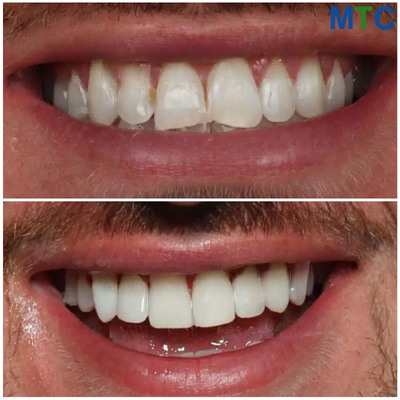 Dental Veneers - Before & After