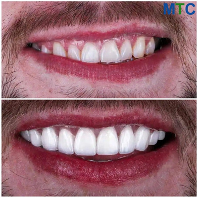 before_after-veneers