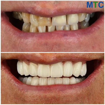 Porcelain Veneers - Before & After