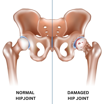 Animated diagram comparing normal hip joint and hip joint with arthritis