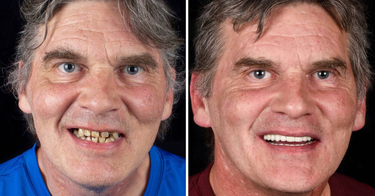 Full Mouth Reconstruction in Tijuana, Mexico