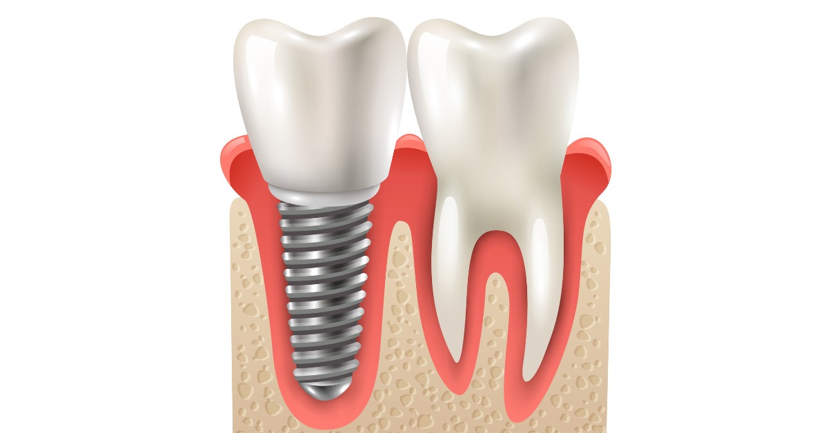 Zygomatic Dental Implants in Mexico