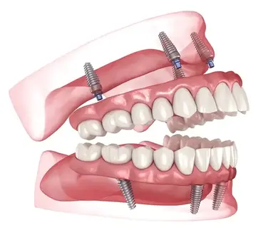 Al-on-4 dental implants for both arches