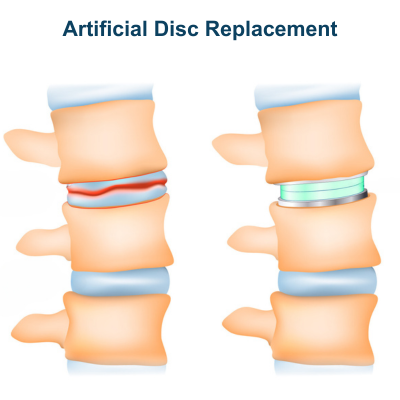 Artificial Disc Replacement