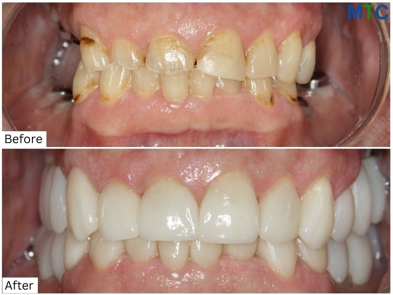 Before & After Dental Work in Puerto Vallarta, Mexico