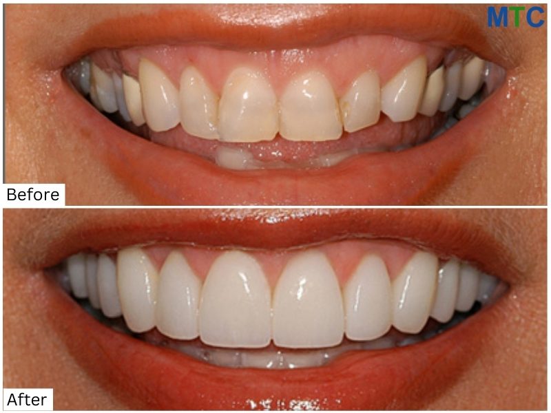 Before & After Dental Work in Puerto Vallarta, Mexico