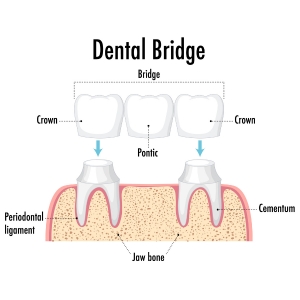 Dental Bridge