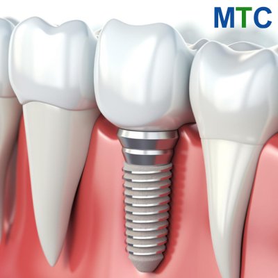 Dental Implant