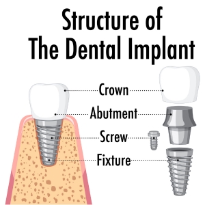 Dental implant