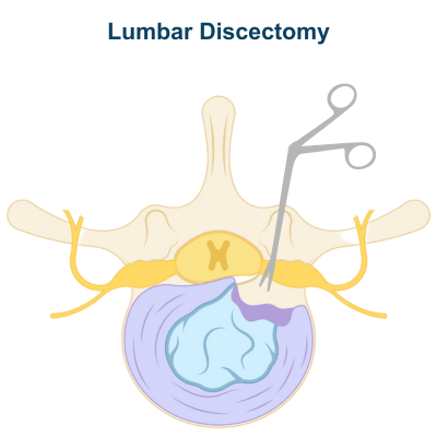 Lumbar Discectomy