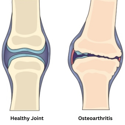 a diagram depicting the difference between a normal and damaged knee joint