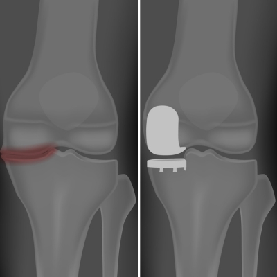 An X-ray depicting before and after getting partial knee replacement