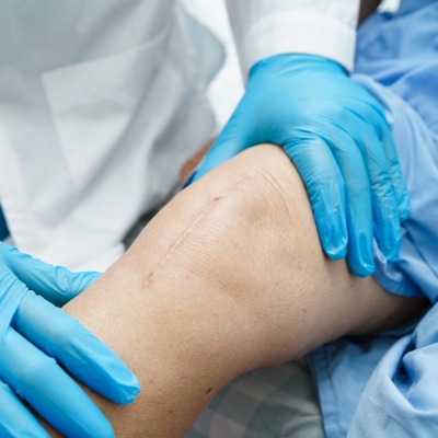 A surgeon examining a prior knee replacement scar