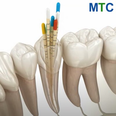 Root canal treatment