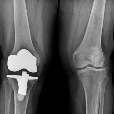 An X-ray depicting knee replacement done on one knee