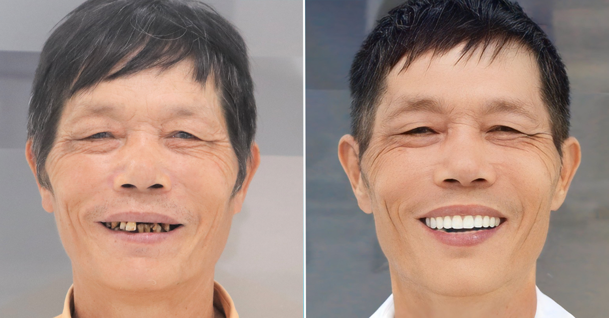 Dental Implants in Hanoi, Vietnam