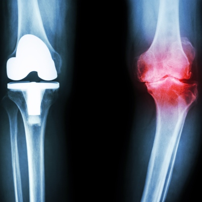 X-ray image of a knee with osteoarthritis and an artificial joint