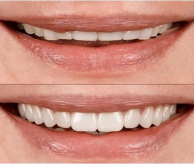 28 Crowns - Hollywood Smile Makeover, at BFC Dental Bangna