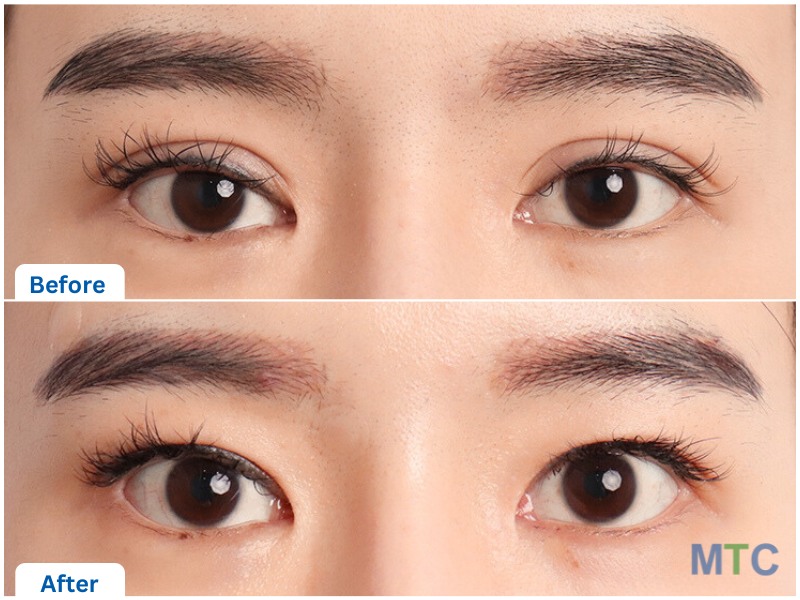 Korean Blepharoplasty Before and After Results