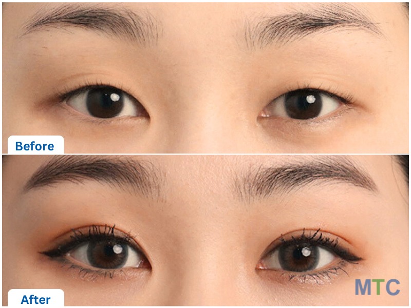 Korean Blepharoplasty Before and After Results