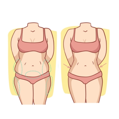 tummy tuck diagram