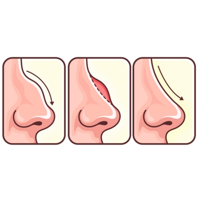 rhinoplasty diagram