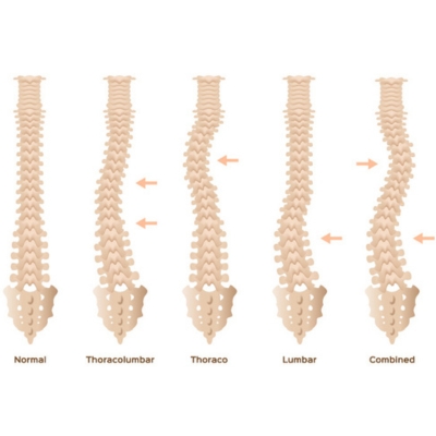 Scoliosis Correction Surgery