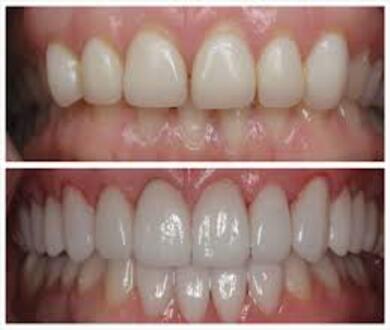 Porcelain Veneers - before and after, hollywood smile makeover package at BFC Dental, Bangna