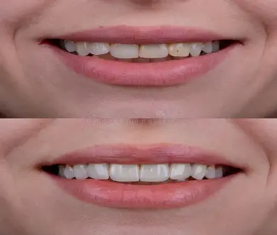 Ceramic Veneer - Hollywood Smile Makover Package at BFC Dental Bangna