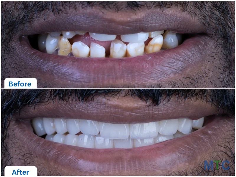 Before and after dental implants, Hyderabad