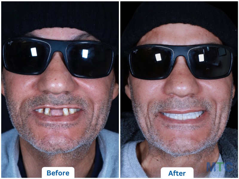  Full mouth dental implants in Bangalore: before image with loose teeth and gum recession and after image with a restored, natural-looking smile.