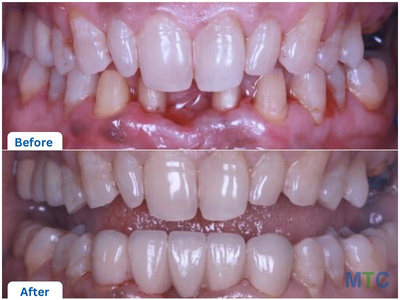 Before and after dental implants, Hyderabad