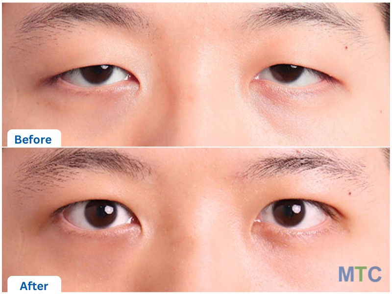 Results of Male Blepharoplasty