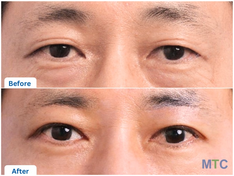 Korean Blepharoplasty Before and After Results