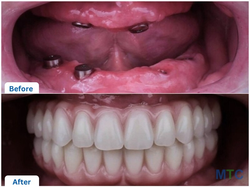 Before and after dental implants, Hyderabad