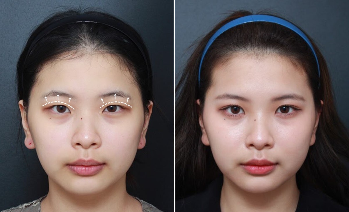 Double Eyelid Surgery or Asian Blepharoplasty in Seoul, Korea