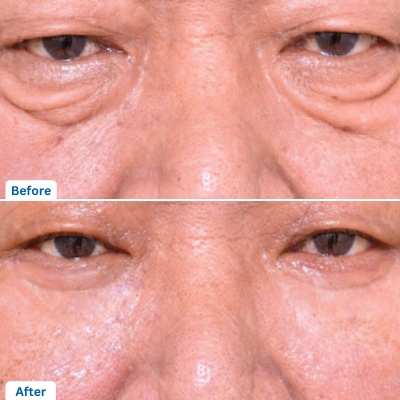 Eyelid Surgery for Men