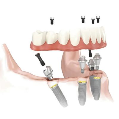 All on 4 Dental implants