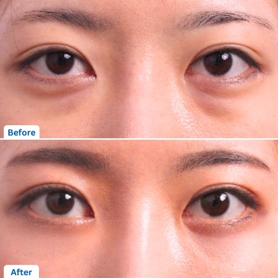 Under Eye Fat Reposition