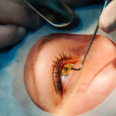 Cataract treatment