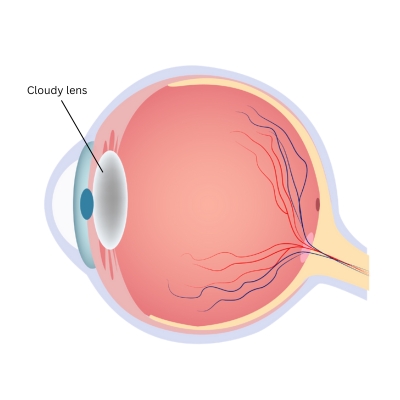 Lens with cataract