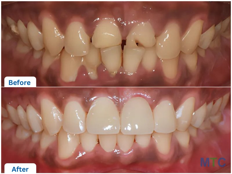 Aesthetic dental crowns before and after images