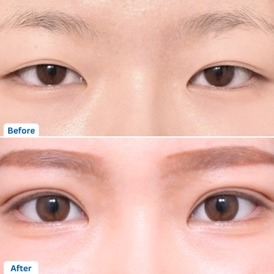 Double Eyelid Surgery or Asian Blepharoplasty