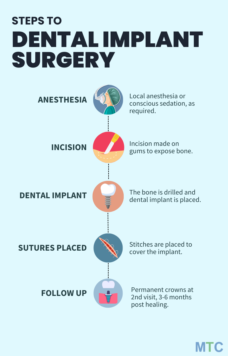 Steps to dental implant surgery