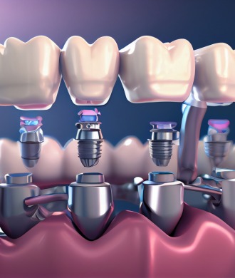 Dental Implants Package GIza