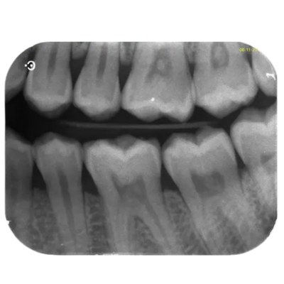 Digital X-Rays