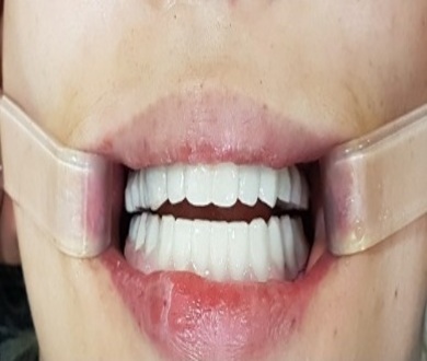 Full Mouth Implants package