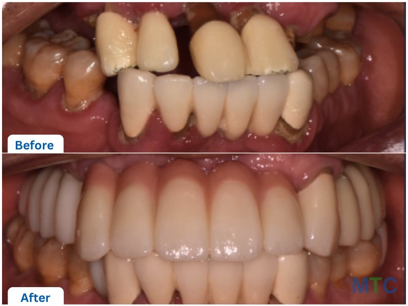 Full Mouth Rehabilitation before and after