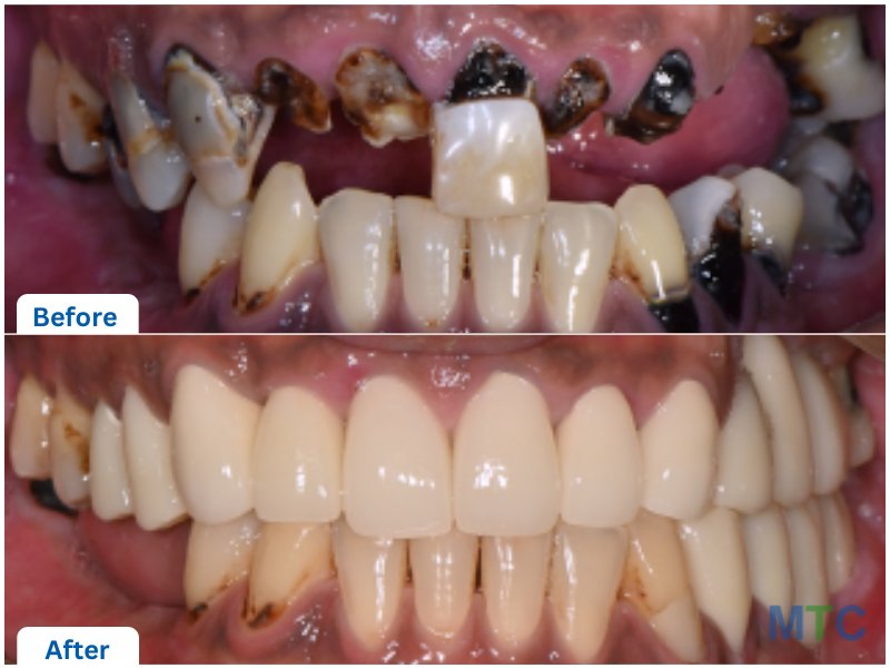 Full Mouth Rehabilitation-Implants and Crowns before and after images