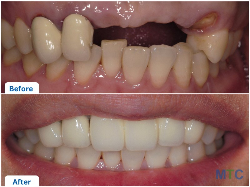 Dental Implants - Front Region before and after